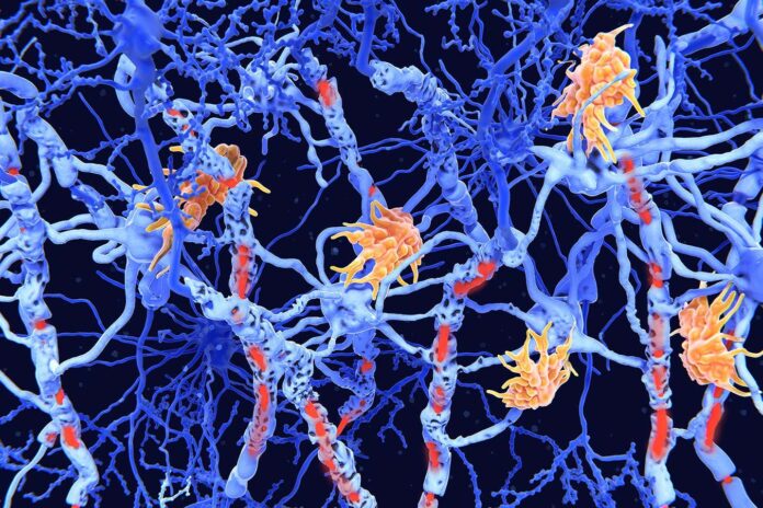 Genetic marker for multiple sclerosis severity discovered


