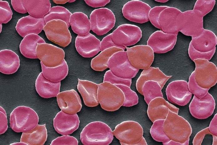 A scanning electron micrograph of blood from someone with iron deficiency anaemia, showing irregularly-shaped, small red blood cells