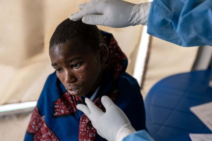 How deadly is mpox and what treatments are available?